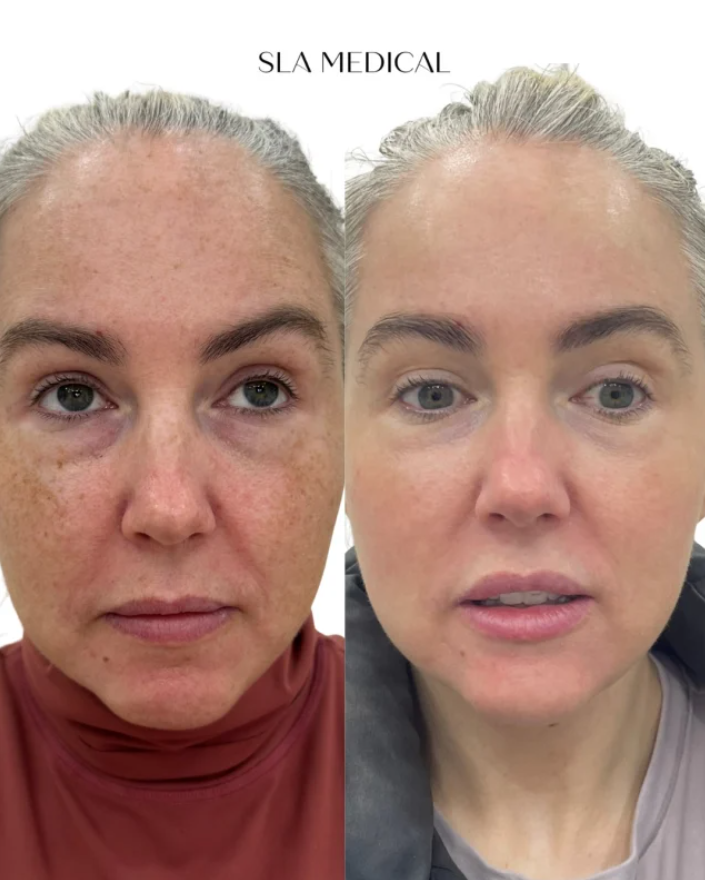 Melasma In Manchester