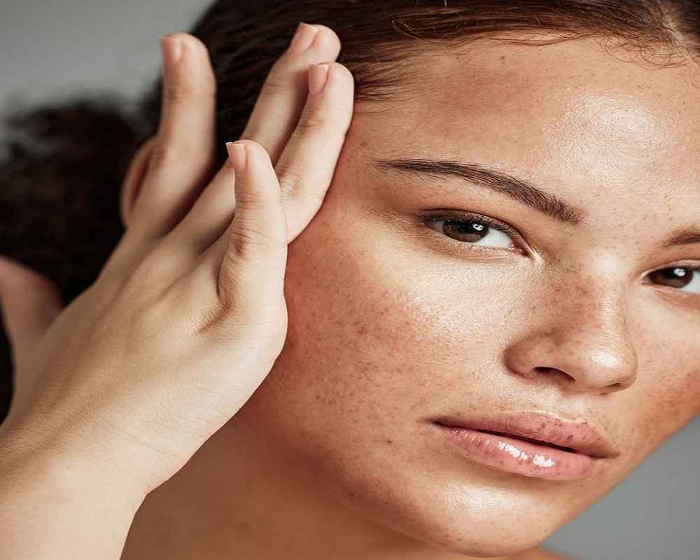 Melasma Treatment in Islamabad