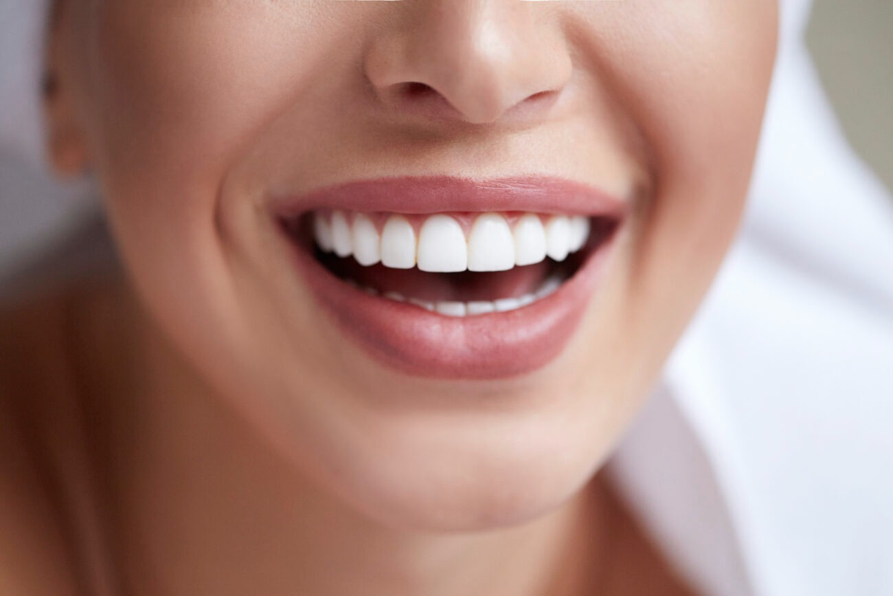 Porcelain Veneers