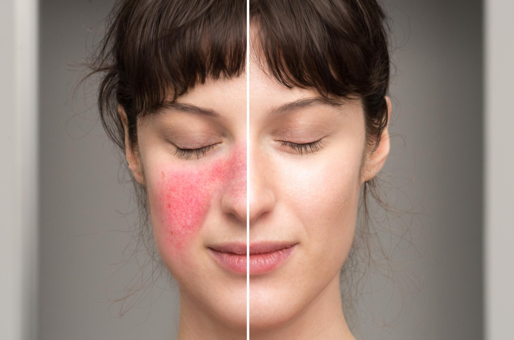 Understanding Rosacea & Treatments in Manchester