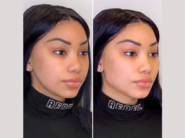 Thread Lift Solutions at the Best Aesthetic Clinics in Dubai for Rejuvenation