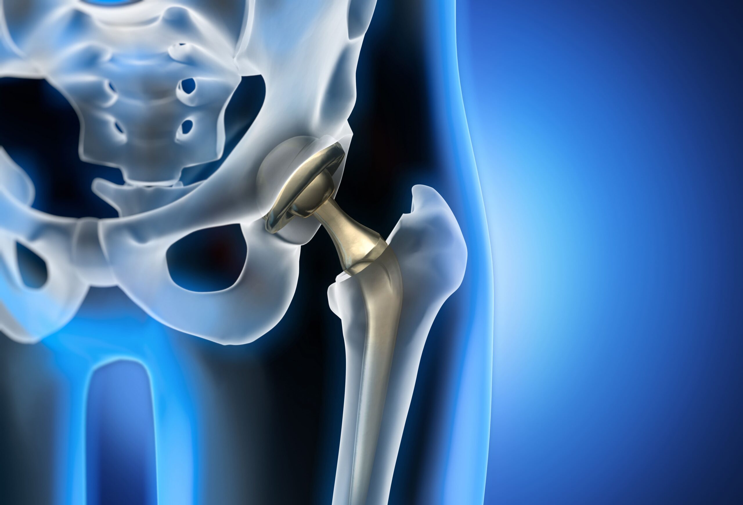 hip replacement last