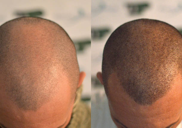scalp micropigmentation in islamabad